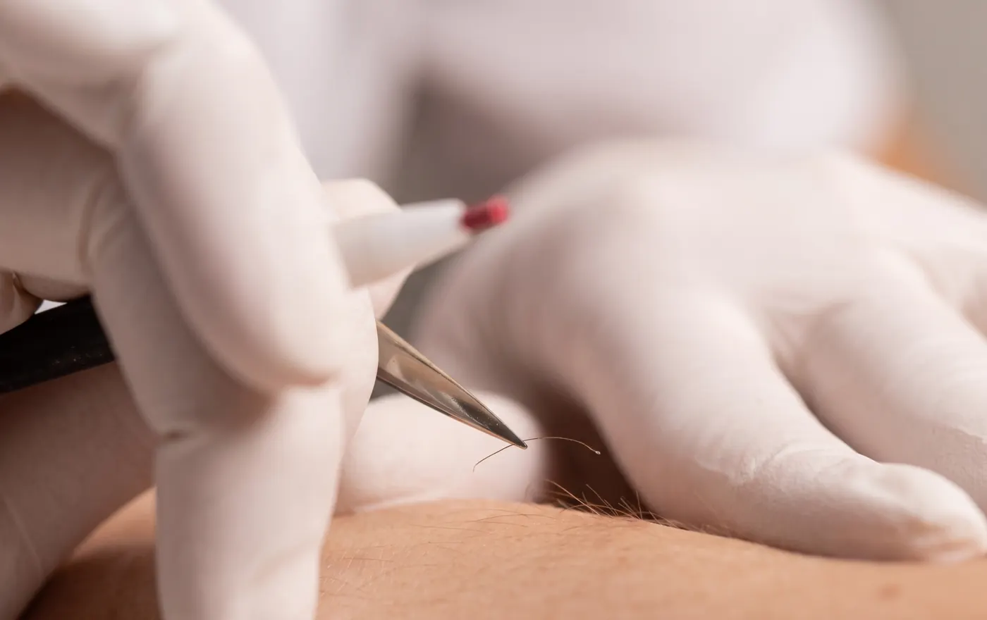 Behandlung mit der mikrofeinen Sonde: behandschuhte Hände führen die Sonde an ein Haar